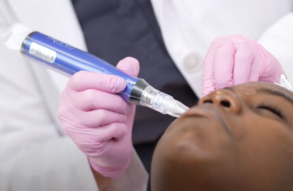 microneedling in Ashburn & Leesburg