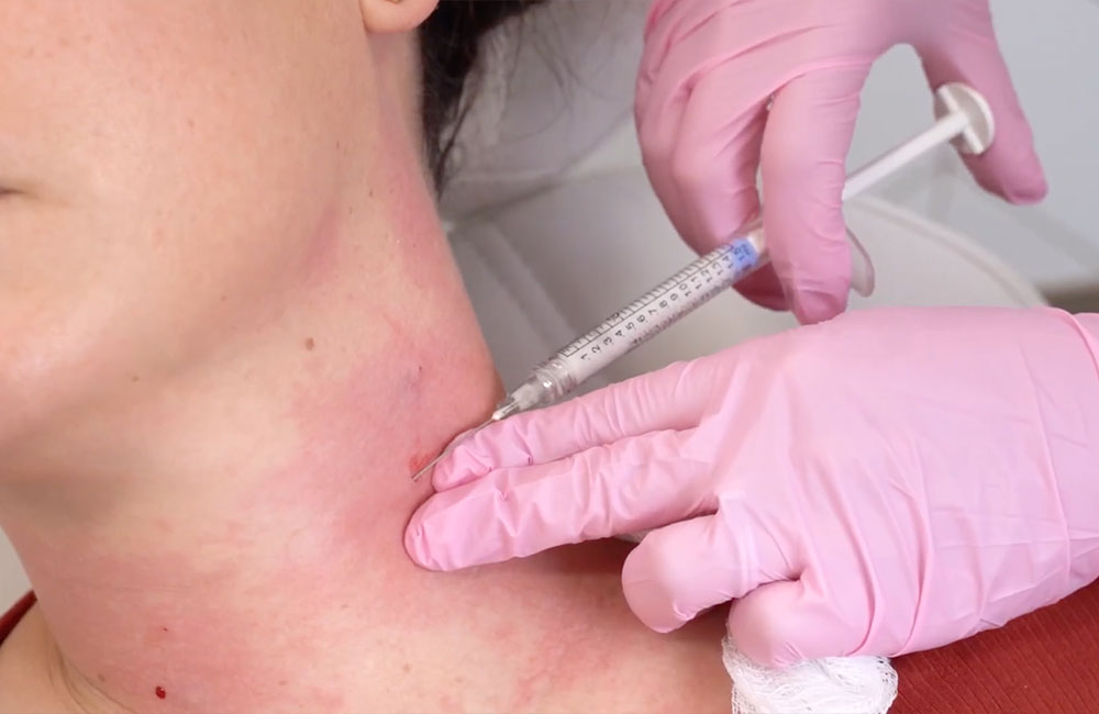 woman getting neck treatment with radiesse in ashburn & leesburg